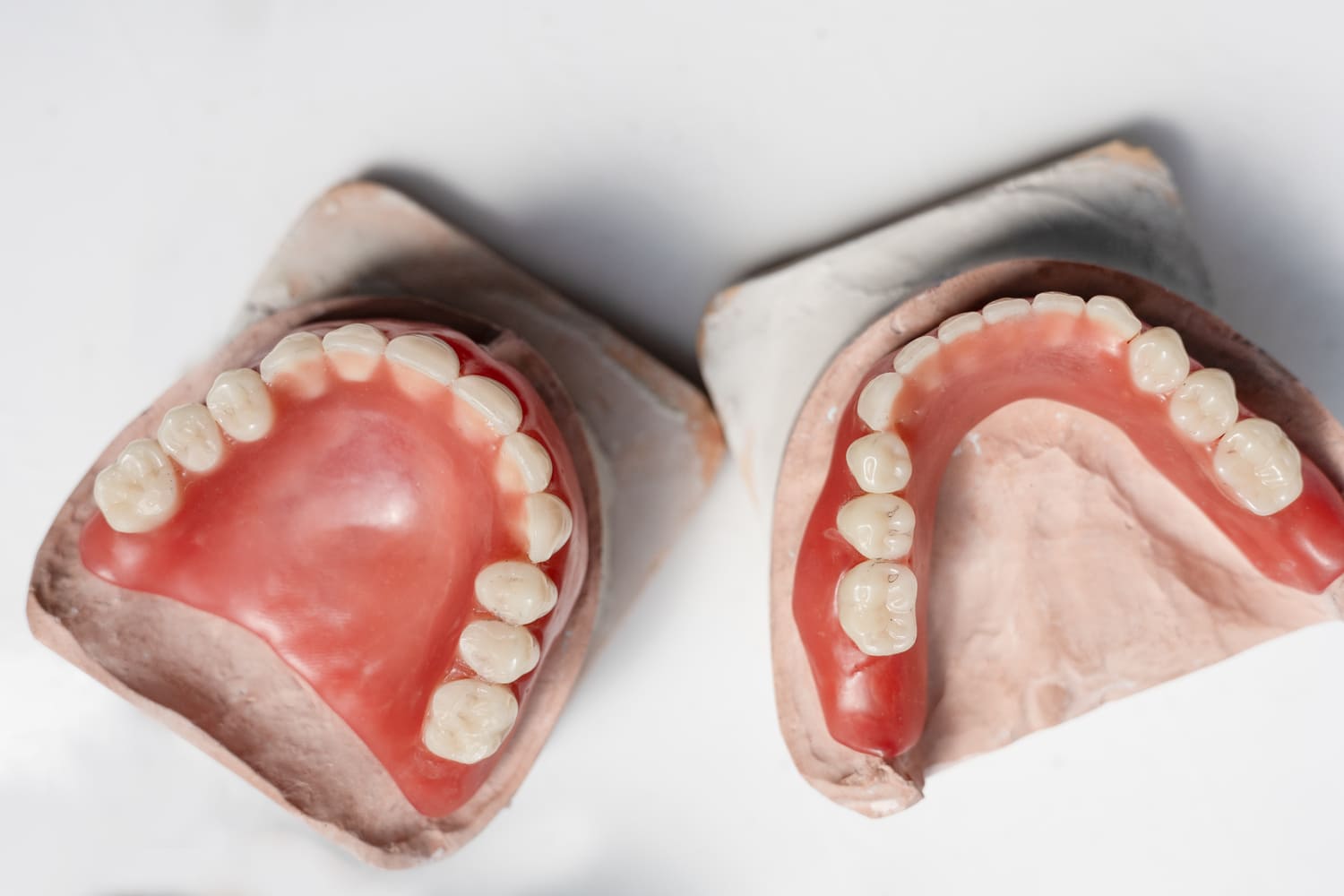 implantes vs dentadura implantes vs dentadura
